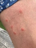 Swimmers Itch example